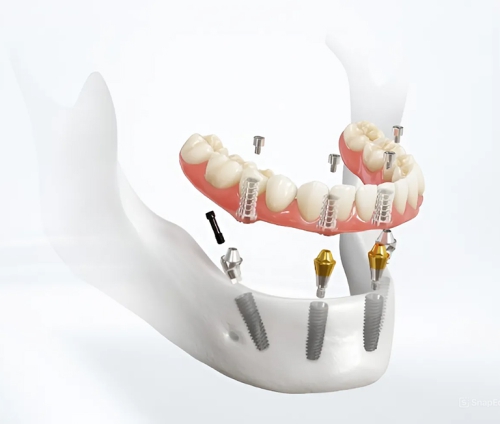 İmplant Üstü Protezlerde Vidalı mı Simante mi? Avantaj & Dezavantaj Karşılaştırması