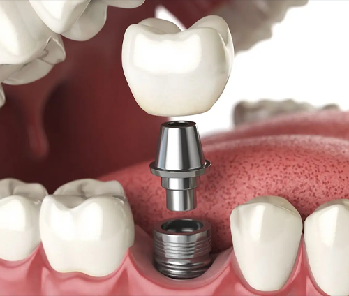İmplant Cerrahisinde En Çok Yapılan Hatalar ve Önlemenin Yolları