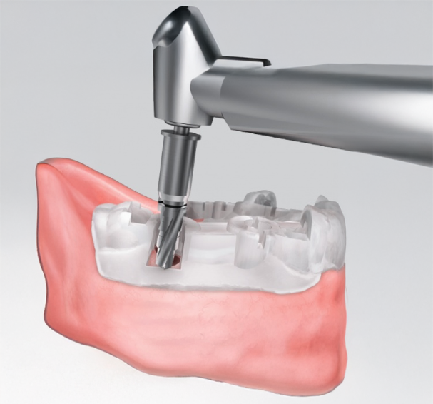 Dijital Planlamada Yeni Çağ: OneGuide ile Hatasız Cerrahi Mümkün mü?