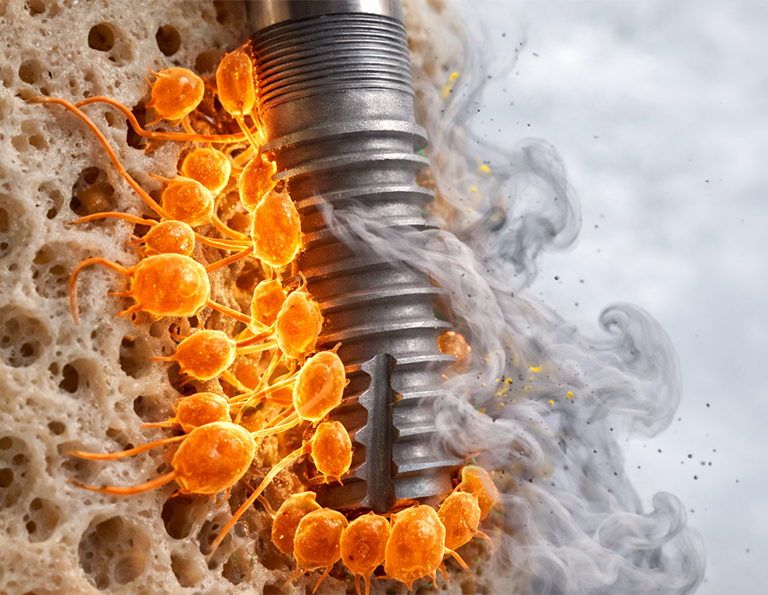 Sigara Kullanımı Dental İmplant Başarısını Nasıl Etkiler?