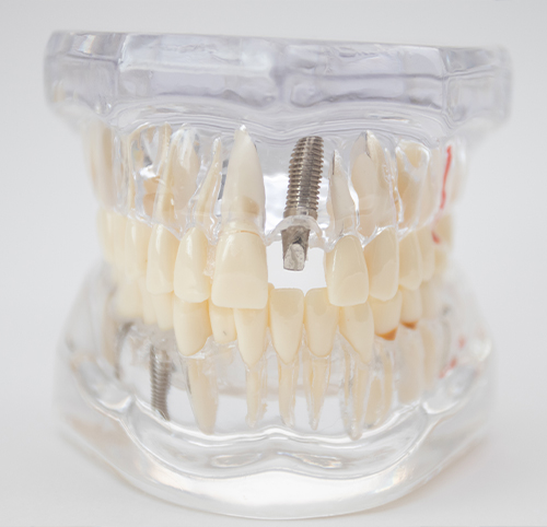 Zorlu İmplant Vakalarda Mükemmel Uyum: Osstem Multi Açılı Abutment