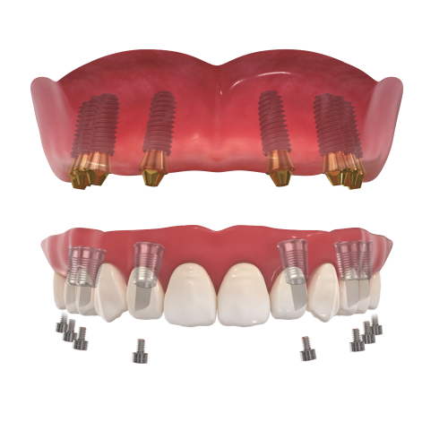 All-on-4 ve All-on-6 Uygulamaları: Kimler İçin Uygun, Avantajları Nelerdir?