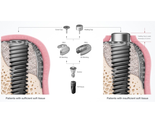 Zayıf Kemik Yapısında İmplant Planlaması: Kemik Grefti mi? Açılı İmplant mı?